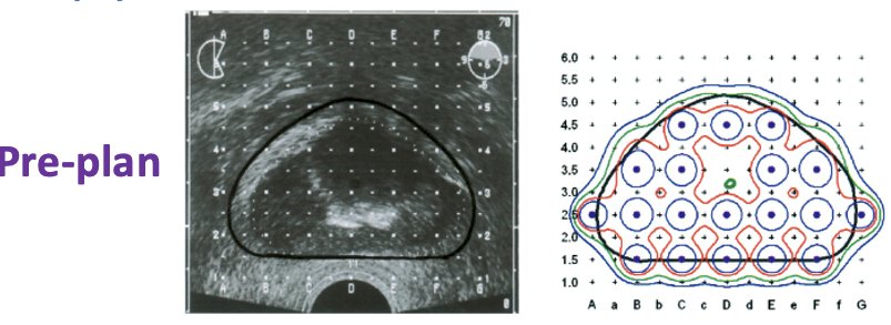 Prostate target volume: prostate + 5 mm margin, except 0 mm margin posteriorly and 10 mm proximal seminal vesicle