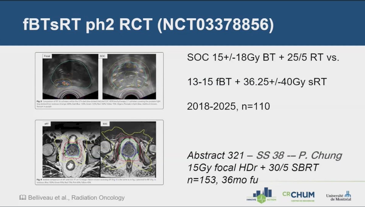 This study is a large (n=153), single-institution, single-arm cohort that explores a 15 Gy focal HDR boost to 30 Gy in 5 fractions of SBRT