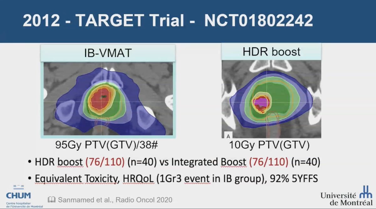 The TARGET trial (NCT01802242) compared an internal boost using Volumetric Modulated Arc Therapy (VMAT) delivering 95 Gy to the planning target volume (PTV, or gross tumor volume [GTV]) in 38 fractions versus an HDR boost of 10 Gy to the PTV (GTV)