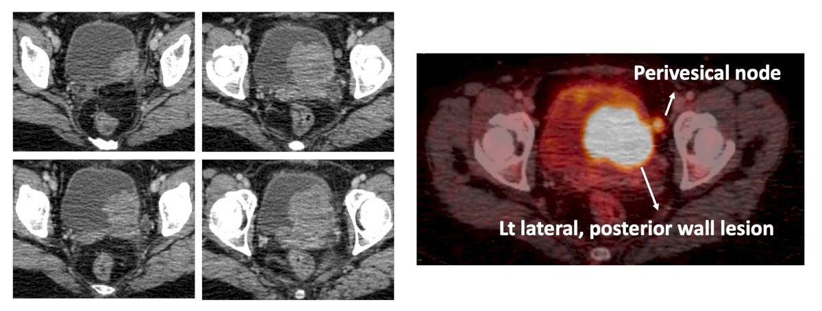 clinical case of a 53 year old female who underwent a TURBT that showed 95% small cell carcinoma histology and 5% urothelial. The staging CT scan is as follows, confirming T3N1M0 small cell carcinoma of the bladder: