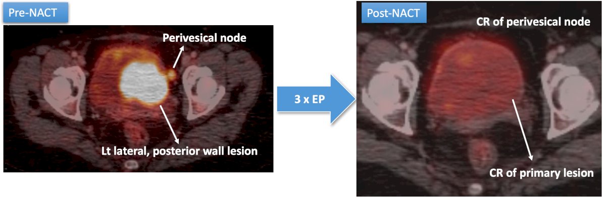 The patient in the aforementioned case did undergo neoadjuvant chemotherapy with 3 cycles of cisplatin + etoposide, with a complete response to the primary lesion