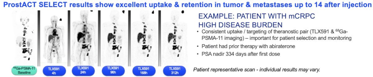 TLX591 utilizes a PSMA-targeted monoclonal antibody (mAb) approach. mAbs are highly specific with low rates of off-target organ exposure, demonstrate prolonged retention in PSMA-positive tumors, and have a predictable safety profile. Two treatments are administered 14 days apart