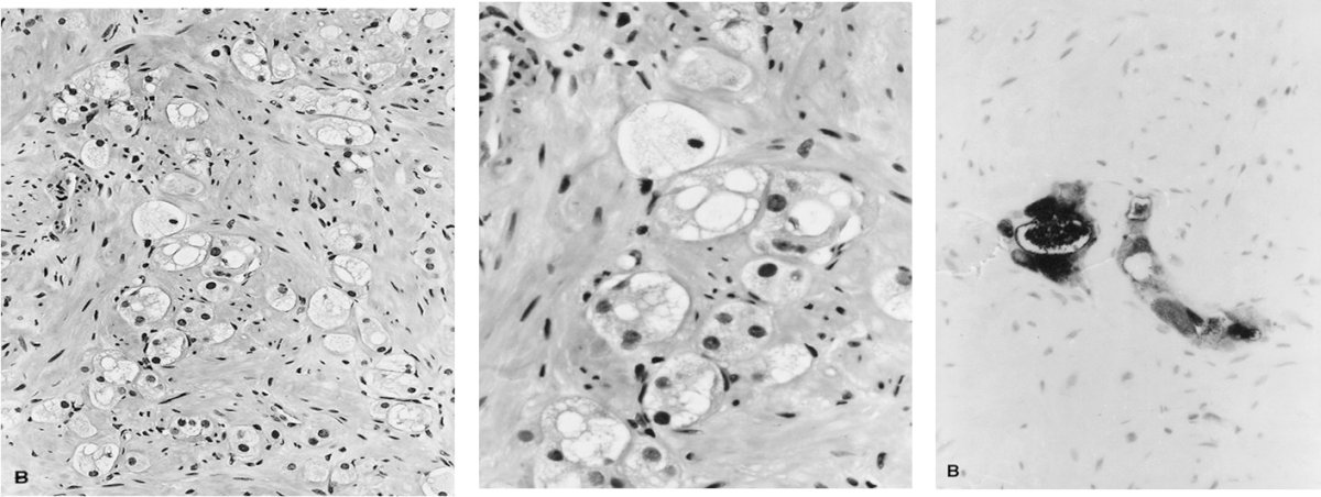 Post radiotherapy recurrence, an MRI prostate should be performed with contrast, and the prostate biopsy should be systematic + targeted biopsies and include the seminal vesicles. Importantly, Dr. Ehdaie states that a focused effort should also be made to biopsy medial tissue adjacent to the urethra as this is a sanctuary site of recurrent disease. Of note, prostate adenocarcinoma with “treatment effect” is not disease recurrence