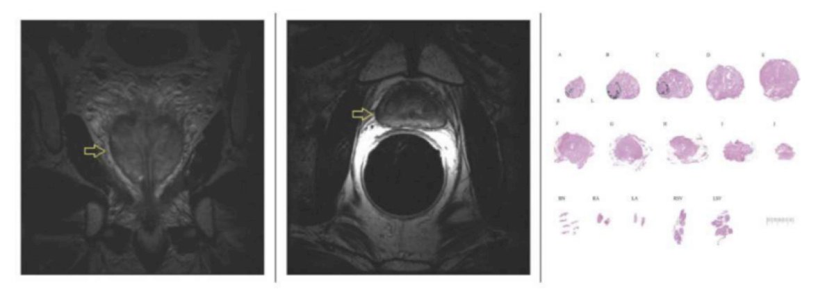 The primary outcome was the ability of clinicopathologic and imaging criteria to identify patients who may be eligible for salvage partial gland ablation based on detailed tumor map from whole-mount salvage radical prostatectomy slides. Of these 77 patients, 15 patients (19%) were determined to be eligible for salvage partial gland ablation based on biopsy-proven unilateral disease in contiguous sextant segments, a dominant lesion on MRI concordant with biopsy location or no focal region of interest, and no imaging evidence of extraprostatic disease