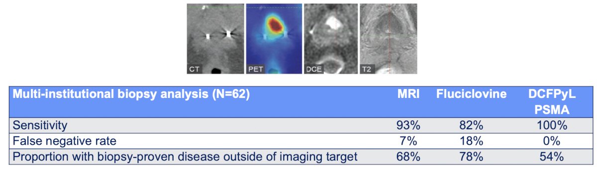 Additionally, a prostate biopsy is required, since the most common sites of false positive on 68Ga-PSMA-11 PET/CT is the irradiated prostate. Imaging alone does not reveal the true extent of pathologic involvement