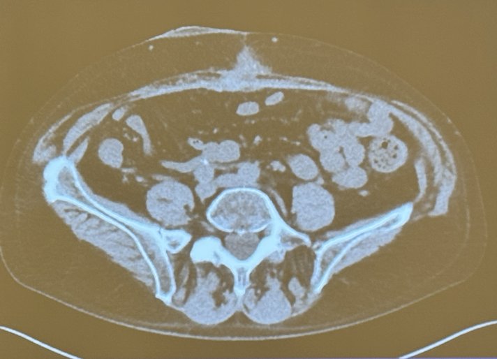 Dr. Wyre likes to keep the stapler line to identify the end of the ileal conduit (IC), as shown in the photo (calcification spot). This helps him locate the ureteroenteric anastomosis and monitor the location of the conduit.