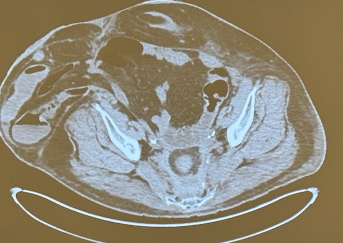 It is a grey area because general surgeons often do not understand the ileal conduit (IC) anatomy and the location of the ureters, and urologists are not typically trained to repair these hernias.