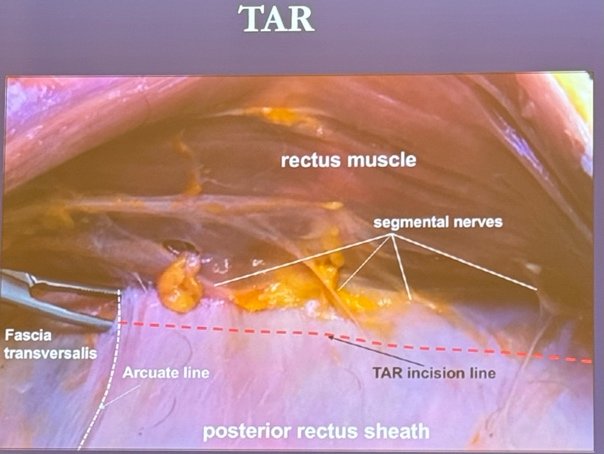 transversus abdominis release (TAR) technique, which is primarily indicated for the repair of large and complex ventral hernias, including incisional hernias. This technique involves accessing the plane of the transversalis fascia and developing the space posterior to the transversus abdominis muscle, allowing for very wide mesh placement, as illustrated below.