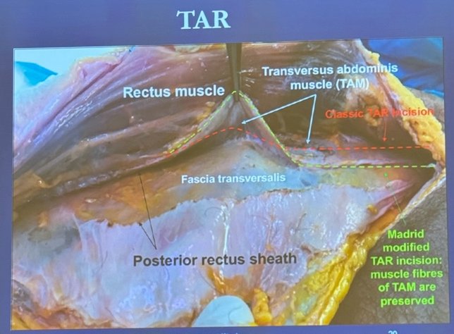 transversus abdominis release (TAR) technique, which is primarily indicated for the repair of large and complex ventral hernias, including incisional hernias. This technique involves accessing the plane of the transversalis fascia and developing the space posterior to the transversus abdominis muscle, allowing for very wide mesh placement, as illustrated below. 2