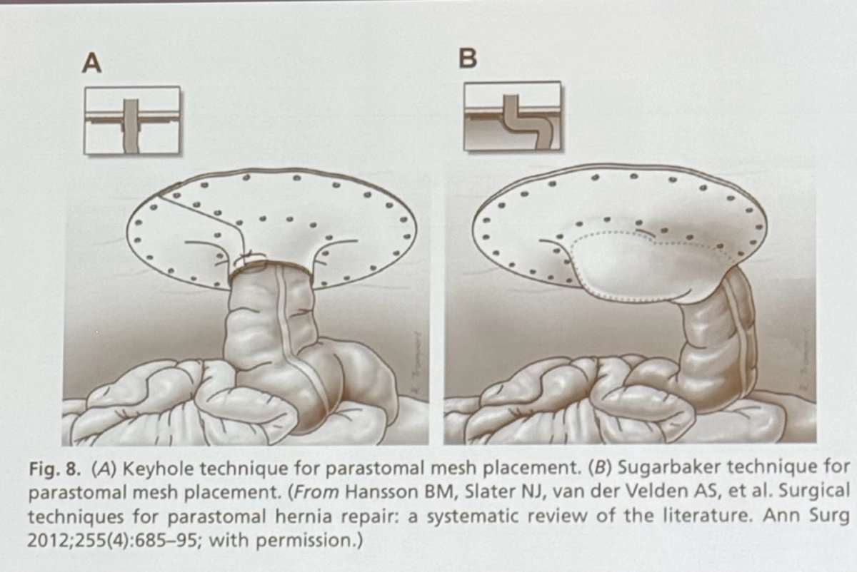 There are essentially two techniques for treating parastomal hernias (shown below): the keyhole technique for parastomal mesh placement and the Sugarbaker technique for parastomal mesh placement.