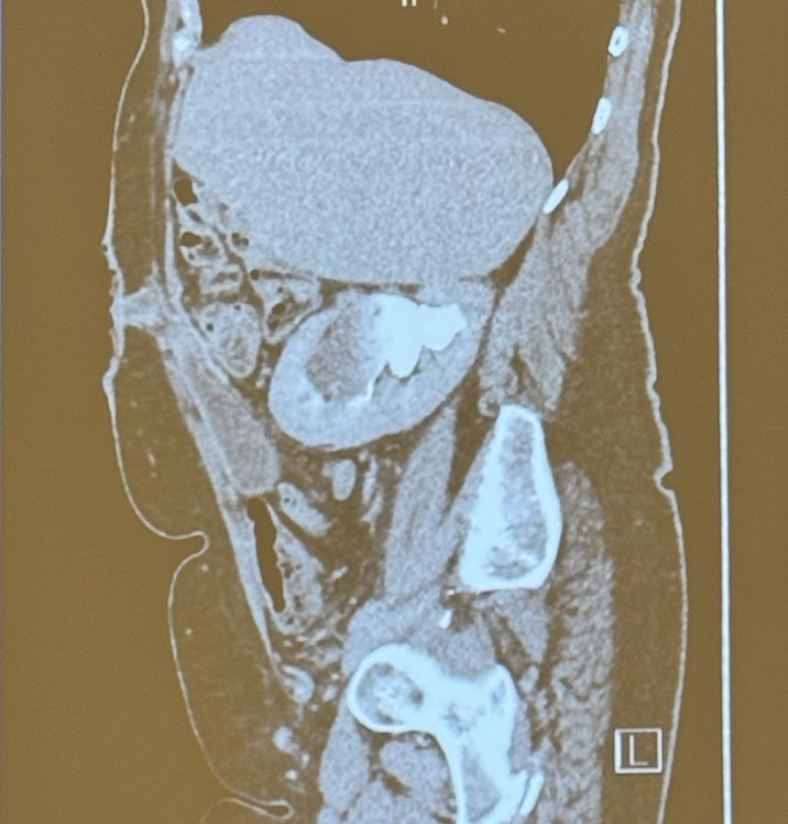 Below there is a CT scan of a patient with a parastomal hernia repair with the modified sugar baker technique