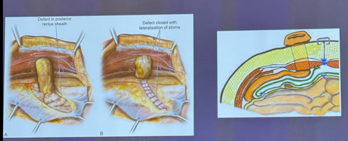 Another parastomal hernia repair technique is the Pauli technique, which involves dissection of the retromuscular space, transversus abdominis release, and lateralization of the stoma with the placement of a retromuscular mesh. Dr. Wyre reserves this technique only for large ventral hernia repairs.