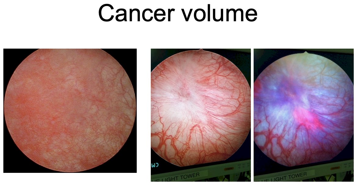 Should all patients be ‘screened’ into these trials with blue light cystoscopies?