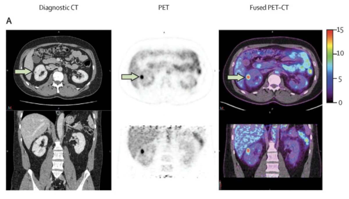 A modern clinical or radiological predictor could be [89Zr]Zr-girentuximab PET/CT. In the ZIRCON study, this imaging modality demonstrated a sensitivity of 85.5% and specificity of 87.0% for clear cell RCC. (3) If used correctly, it could help inform clinical decision-making in the future and potentially predict response to treatment. 