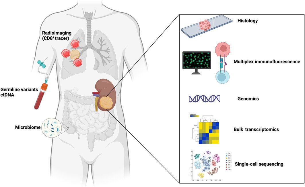 Dr. Ball pivoted to the biomarker space, noting that the study of biomarkers in RCC is gaining significant attention. There are multiple types of biomarkers we can use for detecting and predicting clinical outcomes in RCC, including ctDNA, microbiome analysis, CD8+ tracers, KIM-1, and basic histology subtype analysis.