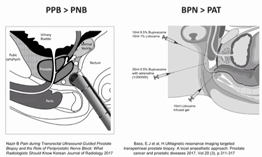 Perineal nerve block versus periprostatic block for patients undergoing  transperineal prostate biopsy (APROPOS): a prospective, multicentre,  randomised controlled study - eClinicalMedicine