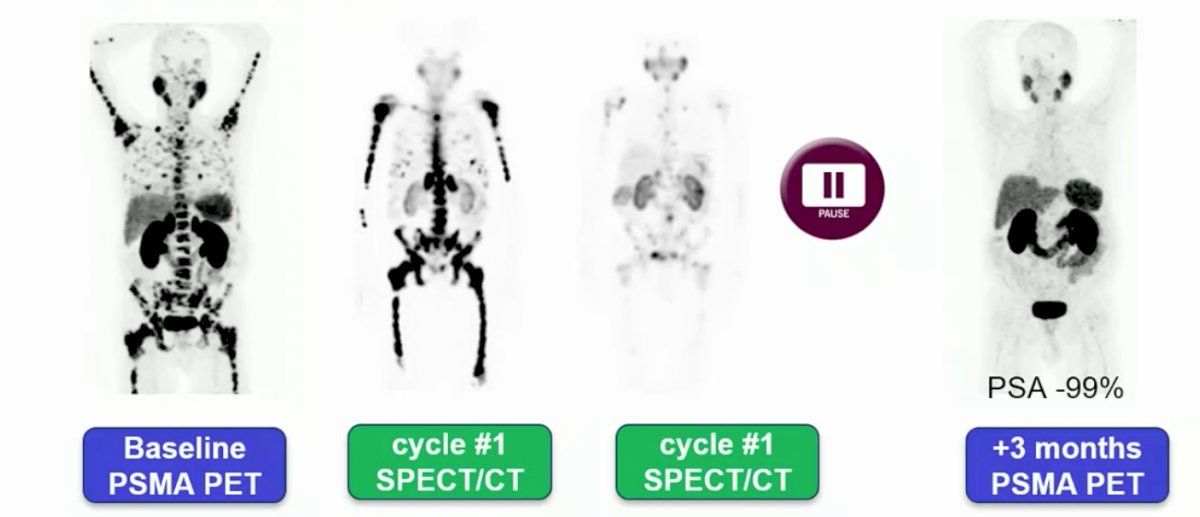 Lu-PSMA13.jpg