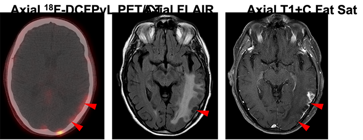 cortical_laminar_necrosis.png