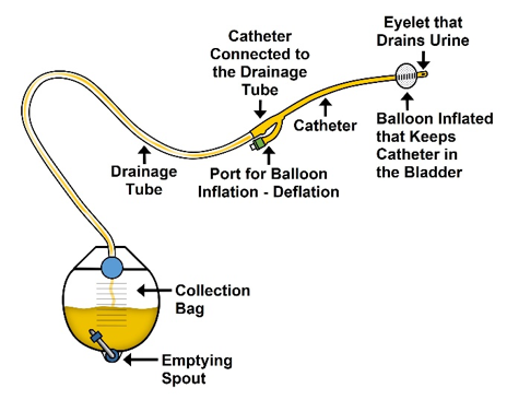 use of indwelling catheters