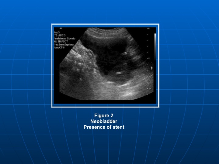 neobladder ultrasound