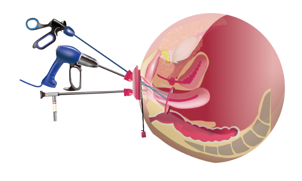 vaginal_Natural_Orifice_Transluminal_Endoscopic_Surgery.jpeg